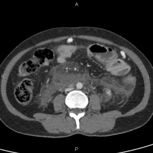 Bilateral adrenal gland hyperenhancement in pancreatitis (Radiopaedia 86642-102753 E 65).jpg