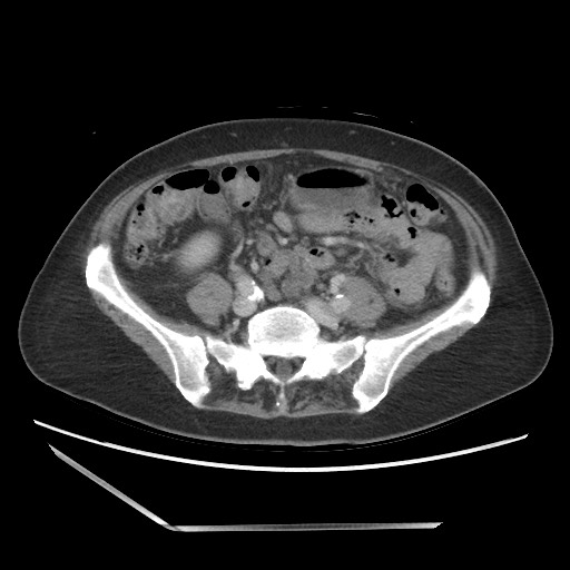File:Bilateral adrenal granulocytic sarcomas (chloromas) (Radiopaedia 78375-91007 A 78).jpg