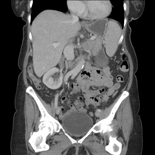 Bilateral adrenal granulocytic sarcomas (chloromas) (Radiopaedia 78375-91007 B 44).jpg