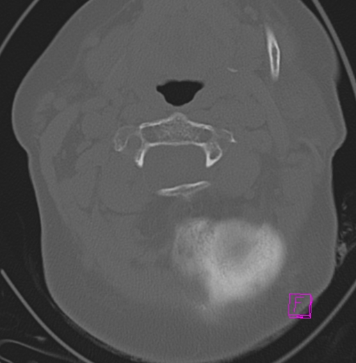 File:Bilateral atlanto-occipital assimilation (Radiopaedia 28350-28603 Axial bone window 13).jpg