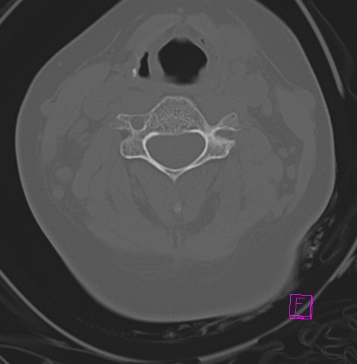 File:Bilateral atlanto-occipital assimilation (Radiopaedia 28350-28603 Axial bone window 21).jpg