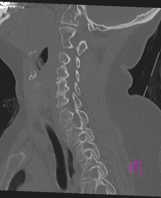 Bilateral atlanto-occipital assimilation (Radiopaedia 28350-28603 Sagittal bone window 48).jpg