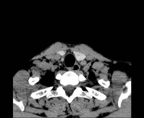 Bilateral carotid body tumors (Radiopaedia 61841-69870 Axial non-contrast 102).jpg