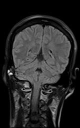 File:Bilateral carotid body tumors and right jugular paraganglioma (Radiopaedia 20024-20060 Coronal 58).jpg