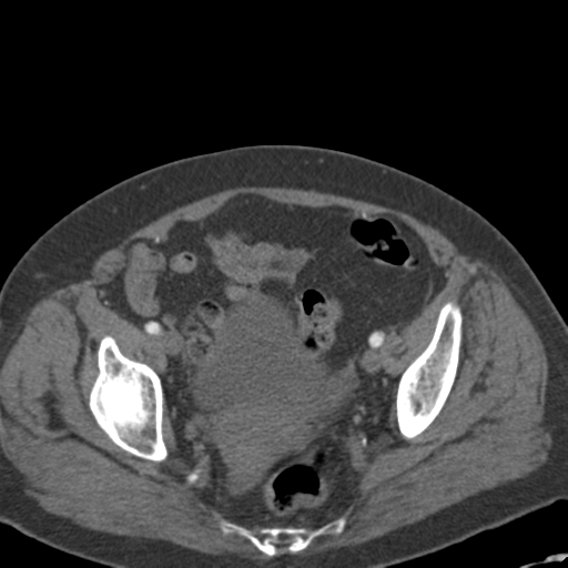 File:Bilateral delayed nephrogram from renal artery stenosis (Radiopaedia 47681-52362 A 56).png