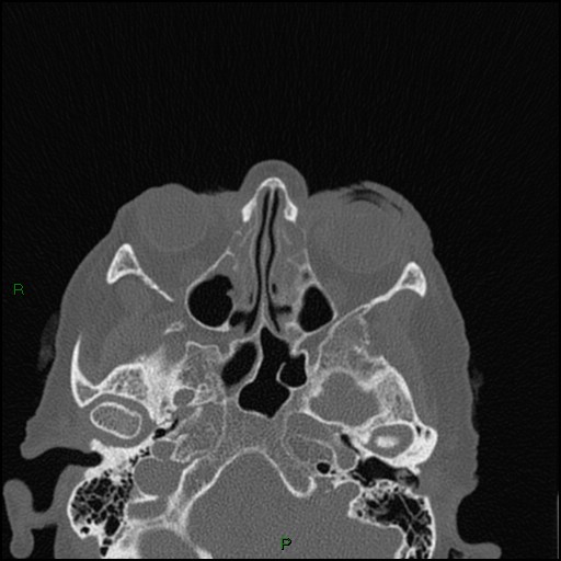 Bilateral frontal mucoceles (Radiopaedia 82352-96454 Axial bone window 161).jpg
