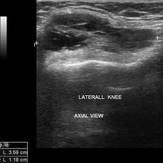 File:Bilateral lateral meniscal cysts (Radiopaedia 12200-12525 Transverse 1).jpg