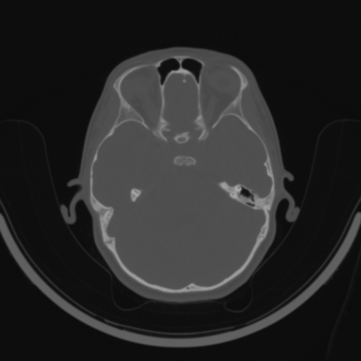 Bilateral otosclerosis (Radiopaedia 57237-64157 C 63).jpg