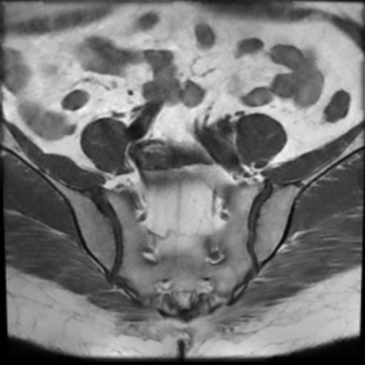 File:Bilateral ovarian dermoid cysts (Radiopaedia 90152-107338 Axial T1 4).jpg