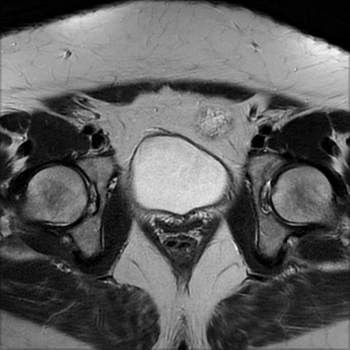 File:Bilateral ovarian dermoid cysts (Radiopaedia 90152-107338 Axial T2 17).jpg