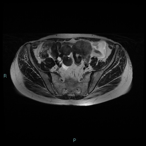 File:Bilateral ovarian fibroma (Radiopaedia 44568-48293 Axial T2 8).jpg
