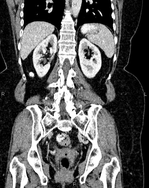 Bilateral ovarian serous cystadenocarcinoma (Radiopaedia 86062-101989 D 36).jpg