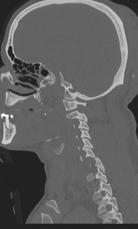 Bilateral perched facet joint (Radiopaedia 63149-71669 Sagittal bone window 7).jpg