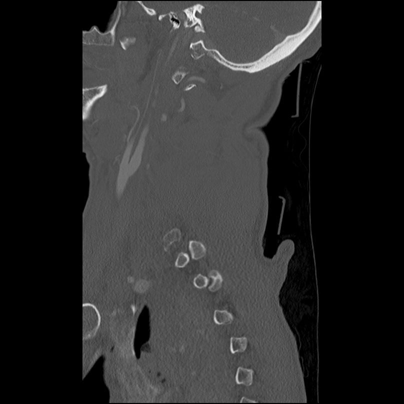 Bilateral perched facets with cord injury (Radiopaedia 45587-49713 Sagittal bone window 9).jpg