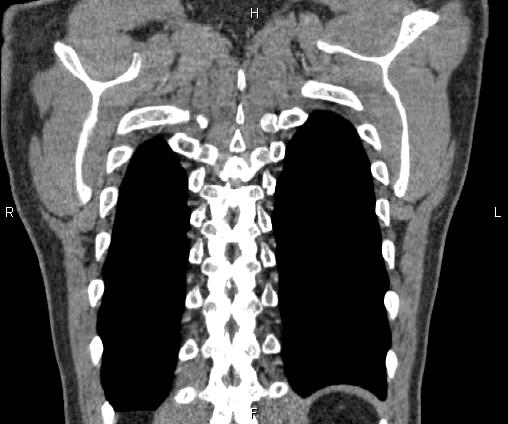 File:Bilateral pulmonary AVM (Radiopaedia 83134-97505 C 66).jpg