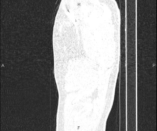 Bilateral pulmonary AVM (Radiopaedia 83134-97505 Sagittal lung window 14).jpg