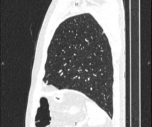 Bilateral pulmonary AVM (Radiopaedia 83134-97505 Sagittal lung window 89).jpg