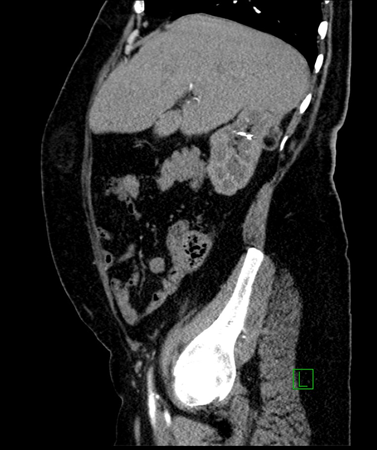 Bilateral sporadic synchronous clear cell renal cell carcinoma (Radiopaedia 85035-100575 E 90).jpg