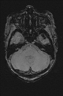 Bilateral subdural hemorrhage and parietal skull fracture (Radiopaedia 26058-26190 Axial SWI 14).png