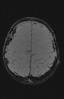 File:Bilateral subdural hemorrhage and parietal skull fracture (Radiopaedia 26058-26190 Axial SWI 64).png