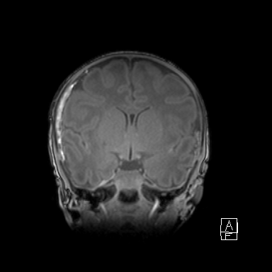 Bilateral subdural hemorrhage and parietal skull fracture (Radiopaedia 26058-26190 Coronal T1 23).png