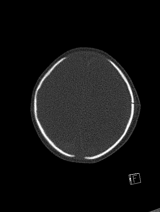 Bilateral subdural hemorrhage and parietal skull fracture (Radiopaedia 26058-26192 Axial bone window 19).png
