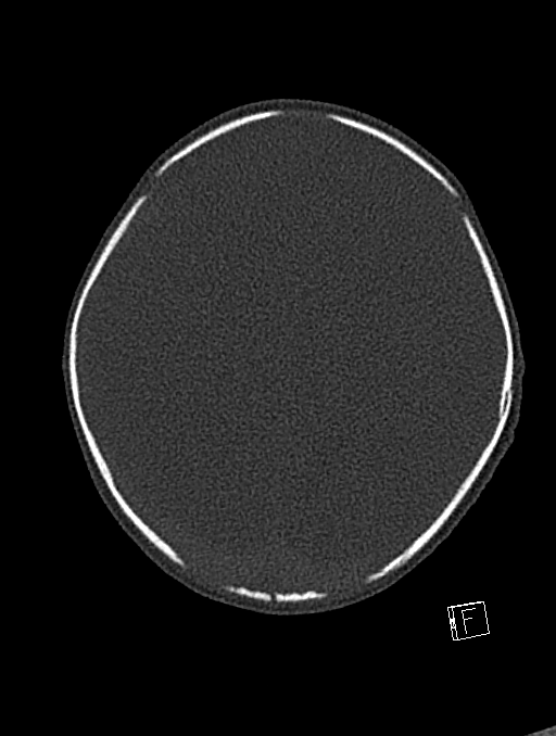 Bilateral subdural hemorrhage and parietal skull fracture (Radiopaedia 26058-26192 Axial bone window 37).png