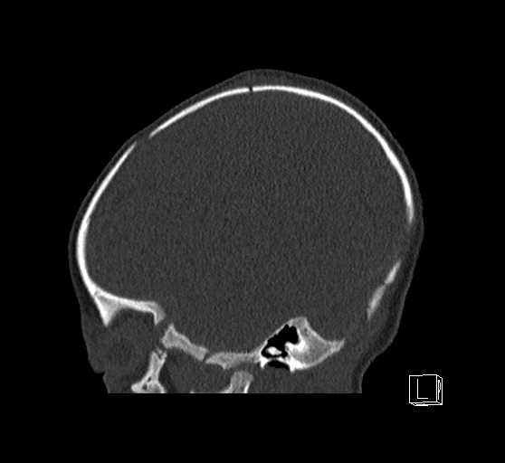 Bilateral subdural hemorrhage and parietal skull fracture (Radiopaedia 26058-26192 Sagittal bone window 77).png
