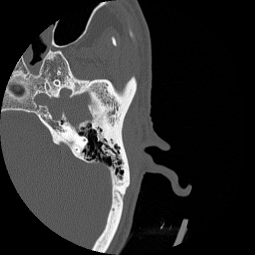 Bilateral temporal bone fractures (Radiopaedia 29482-29970 D 91).jpg