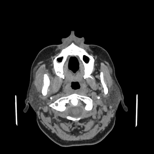 Bisphosphonate-related osteonecrosis of the jaw (Radiopaedia 71324-81642 non-contrast 114).jpg