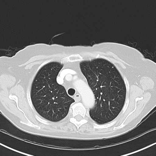 File:Bladder and bowel cancers (Radiopaedia 37688-39592 Axial lung window 14).png