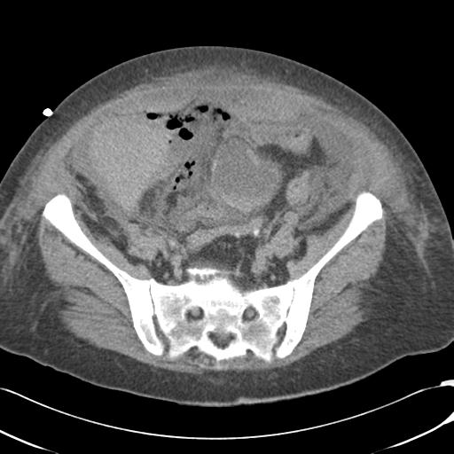 Bladder rupture post renal biopsy (Radiopaedia 30863-31572 Axial non-contrast 65).jpg