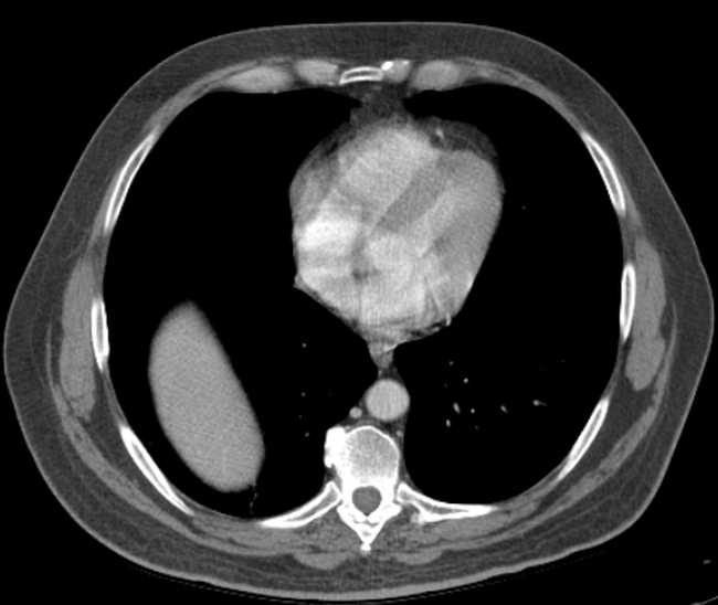 File:Bleeding duodenal ulcer and adenomyomatosis of gallbladder (Radiopaedia 61834-69861 A 3).jpg