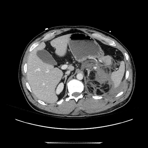 Blunt abdominal trauma with solid organ and musculoskelatal injury with active extravasation (Radiopaedia 68364-77895 A 35).jpg