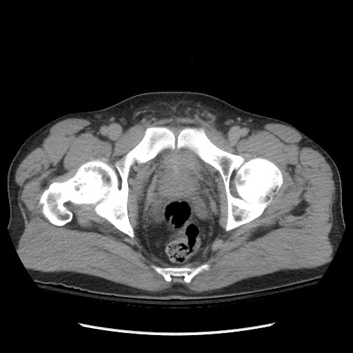 Blunt abdominal trauma with solid organ and musculoskelatal injury with active extravasation (Radiopaedia 68364-77895 Axial C+ delayed 132).jpg