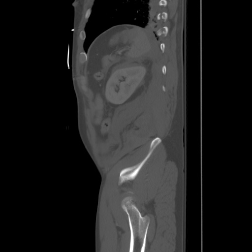 Blunt abdominal trauma with solid organ and musculoskelatal injury with active extravasation (Radiopaedia 68364-77895 Sagittal bone window 91).jpg