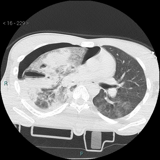Blunt chest trauma (Swiss cheese sign) (Radiopaedia 38519-40618 Axial lung window 32).jpg