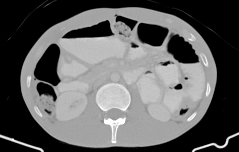 Blunt injury to the small bowel (Radiopaedia 74953-85987 Axial Wide 34).jpg