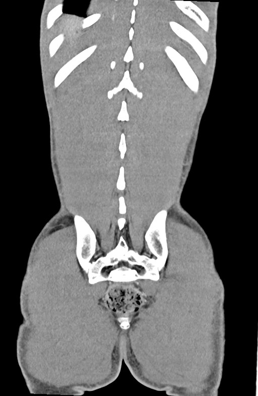 Blunt injury to the small bowel (Radiopaedia 74953-85987 B 84).jpg