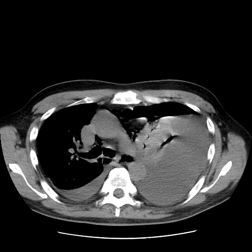 Boerhaave syndrome (Radiopaedia 59796-67310 Axial liver window 26).jpg