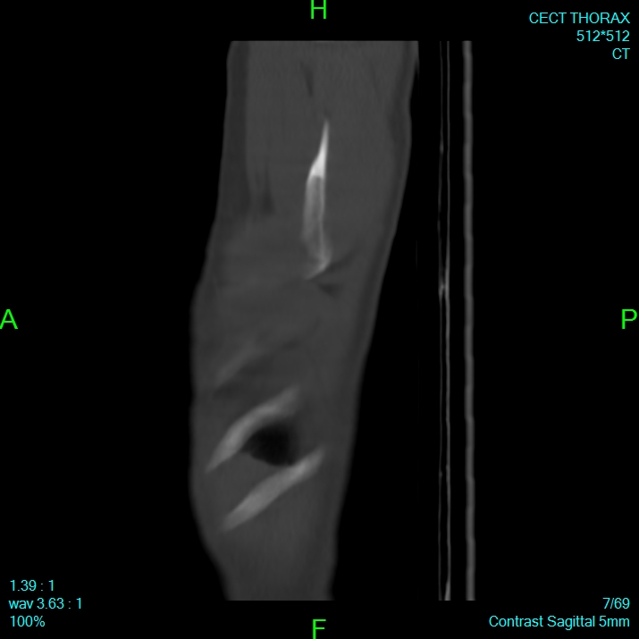 Bone metastases from lung carcinoma (Radiopaedia 54703-60937 Sagittal bone window 7).jpg