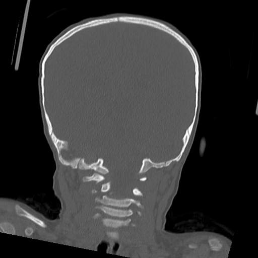 File:Bony atresia of the right external auditory canal (Radiopaedia 27916-28156 Coronal bone window 3).jpg