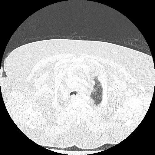 Bovine aortic arch - right internal mammary vein drains into the superior vena cava (Radiopaedia 63296-71875 Axial lung window 22).jpg
