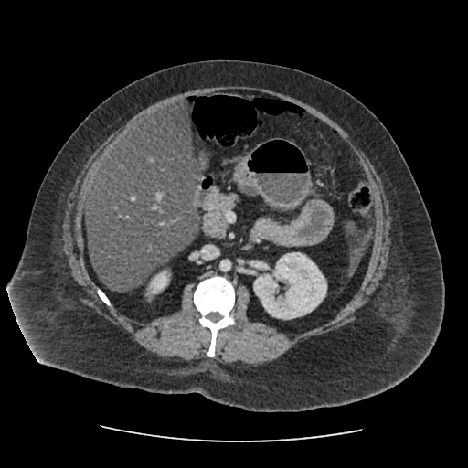 Bowel and splenic infarcts in acute lymphocytic leukemia (Radiopaedia 61055-68915 A 59).jpg