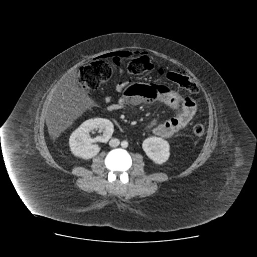 Bowel and splenic infarcts in acute lymphocytic leukemia (Radiopaedia 61055-68915 A 73).jpg