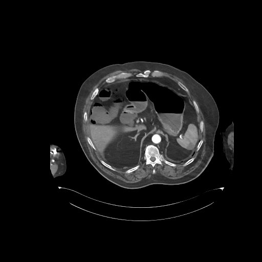 File:Bowel ischemia secondary to SMA occlusion with extensive portomesenteric venous gas (Radiopaedia 54656-60871 A 60).jpg