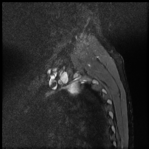 File:Brachial plexus neurofibroma (Radiopaedia 28030-28291 Sagittal STIR 10).png