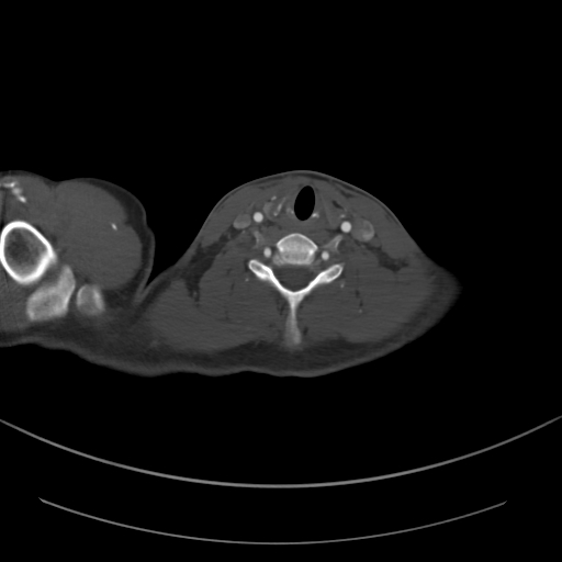 Brachiocephalic trunk pseudoaneurysm (Radiopaedia 70978-81191 Axial bone window 30).jpg