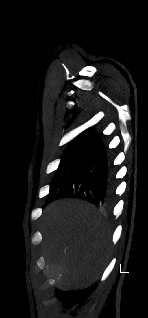 Brachiocephalic trunk pseudoaneurysm (Radiopaedia 70978-81191 C 14).jpg