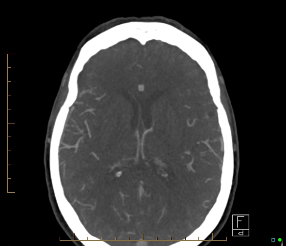 File:Brachiocephalic trunk stenosis (Radiopaedia 87242-103519 A 31).jpg